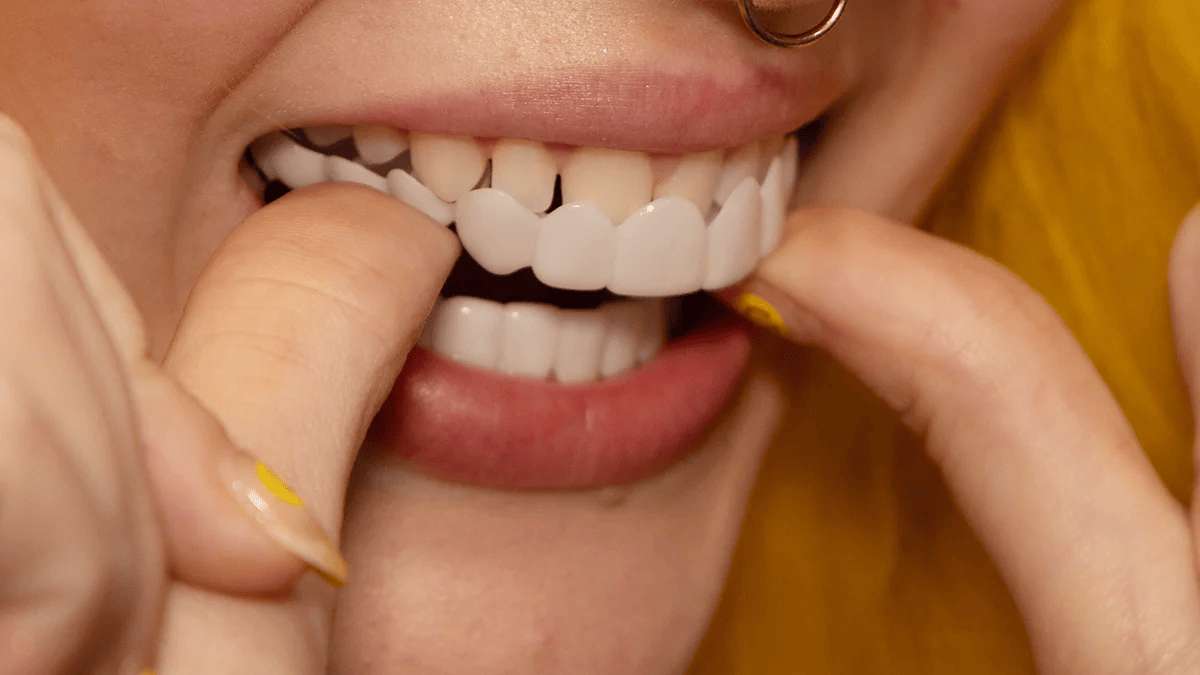 Instant Smile Makeover with Snap-On Veneers