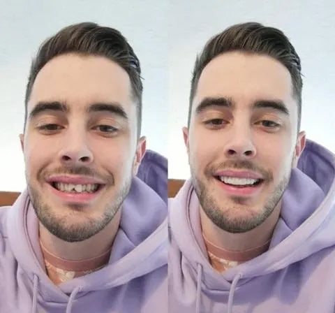 On Smile Veneers for Perfect Teeth (Upper and Lower Included)
