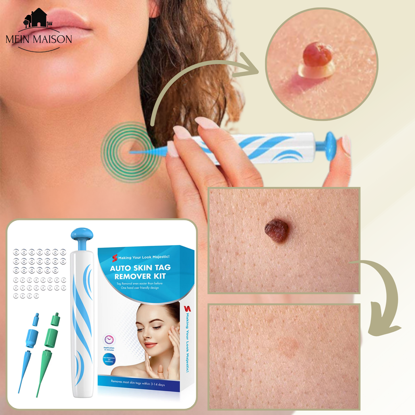 Pain-Free Wart & Mole Remover for Home Use | No Surgery Needed