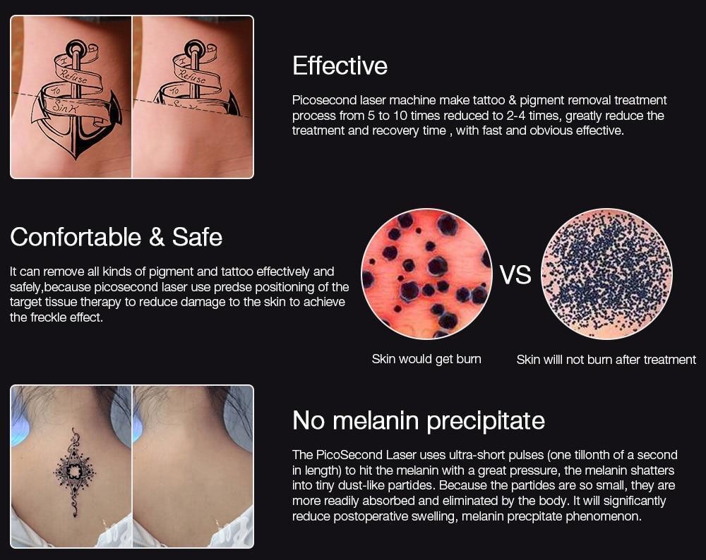 Instant Laser Device for Dark Spots & Tattoo Removal
