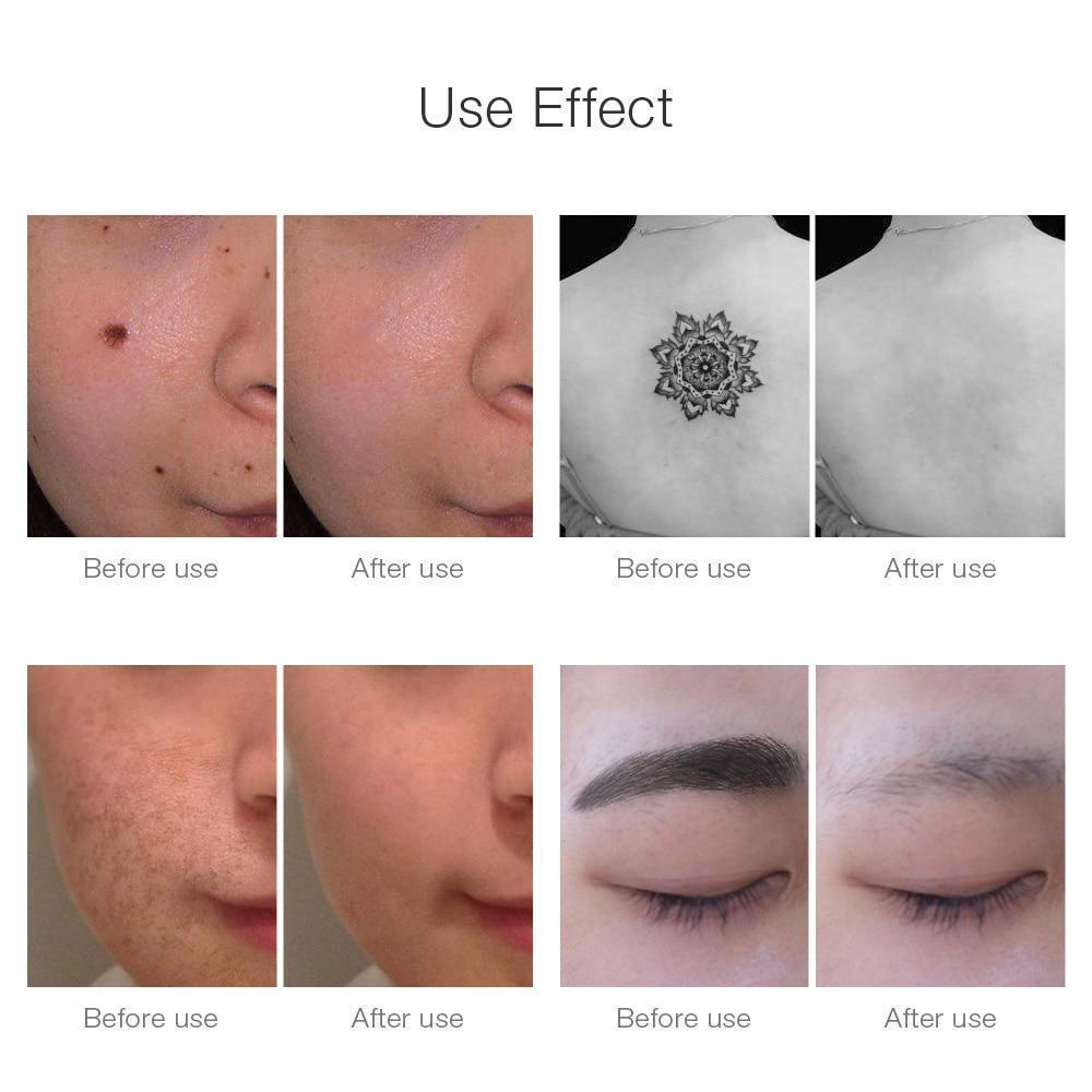 Instant Laser Device for Dark Spots & Tattoo Removal
